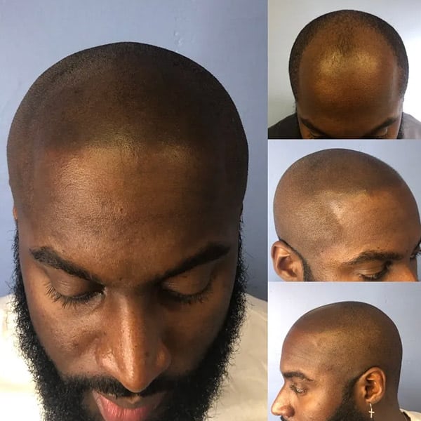 Beauty on Broadway SMP (Scalp Micropigmentation) client results